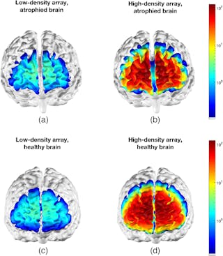 FIGURE 3. Examples of cortical sensitivity of low-density (a, c) and high-density (b, d) array NIR spectroscopy on a brain with severe atrophy due to Alzheimer&rsquo;s disease (a, b) and a healthy brain (c, d).