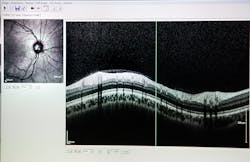 FIGURE 4. OCT image of the optic nerve. FIGURE 4. OCT image of the optic nerve.