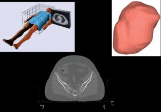 A 3-D reconstruction of a patient-specific bladder was modeled in ASAP. This model helped scientists better understand the results of PDT techniques involving the bladder.