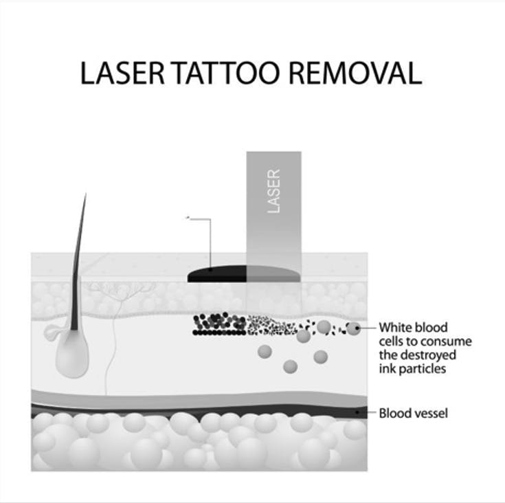 Skin Rejuvenation and Tattoo Removal