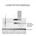 Skin Rejuvenation and Tattoo Removal Skin Rejuvenation and Tattoo Removal