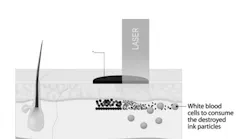 One application of laser optics for skin care is breaking up ink particles for tattoo removal.