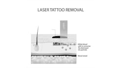 Skin Rejuvenation and Tattoo Removal Skin Rejuvenation and Tattoo Removal