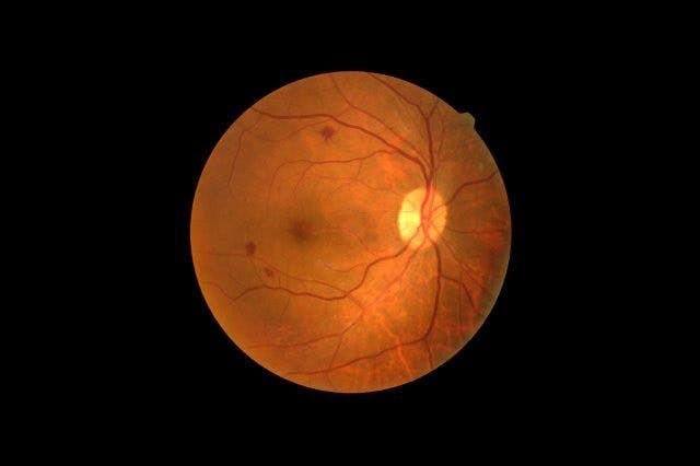 Damaged retinas, such as the one highlighted here, could eventually be replaced by artificial ones made from 2D materials.