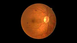 Damaged retinas, such as the one highlighted here, could eventually be replaced by artificial ones made from 2D materials.