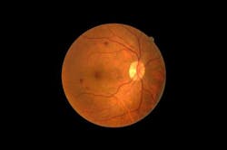 Damaged retinas, such as the one highlighted here, could eventually be replaced by artificial ones made from 2D materials. Damaged retinas, such as the one highlighted here, could eventually be replaced by artificial ones made from 2D materials.