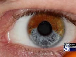 A laser procedure turns brown eyes to blue. A laser procedure turns brown eyes to blue.