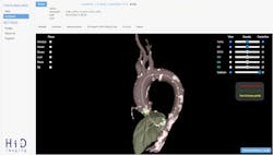 A screenshot of 4TAVR software, a cloud-based AI software platform designed to fully automate anatomical measurements essential for pre-procedural transcatheter aortic valve replacement (TAVR) planning. It offers smart workflow management in clinics and sets a new standard for pre-procedural planning. A screenshot of 4TAVR software, a cloud-based AI software platform designed to fully automate anatomical measurements essential for pre-procedural transcatheter aortic valve replacement (TAVR) planning. It offers smart workflow management in clinics and sets a new standard for pre-procedural planning.