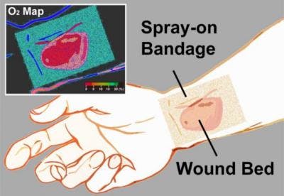 A transparent liquid bandage displays a quantitative, oxygenation-sensitive color map that can be easily acquired using a simple camera or smartphone.