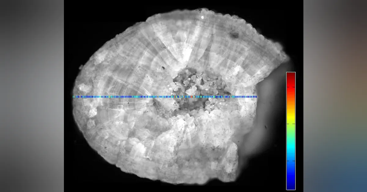 Keyney Raman Raman spectroscopy method can analyze kidney stones rapidly | Laser ...