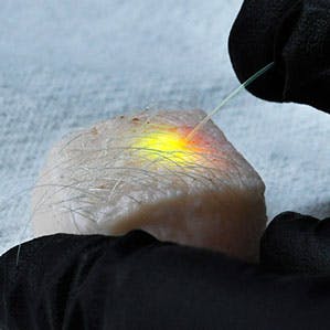 A piece of pig skin glows with laser light after being stimulated by an optical fiber.