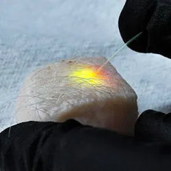 A piece of pig skin glows with laser light after being stimulated by an optical fiber.