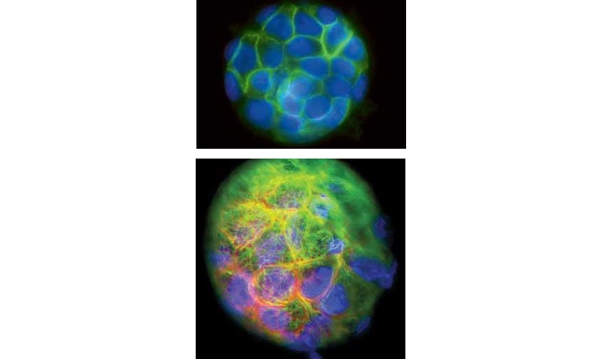 FIGURE 1. Cysts of human kidney cells are shown magnified 400 times; each consists of 50 cells and has a diameter of 350 &micro;m. Below, nuclei are stained with blue and microtubules and actin filaments, both components of the cell skeleton, in green and red respectively. A similar cyst has nuclei in blue and cell membranes in green (above).