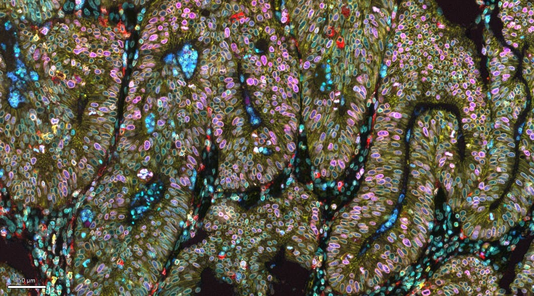 Multiplexed immunofluorescence image of a human colon mucinous adenocarcinoma FFPE tissue section labeled with the ATTOApollo panel, featuring CD45, Ki67, CD11b, CD68, E‑cadherin, Lamin B1, CD20, CD14, and DAPI.