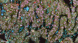 Multiplexed immunofluorescence image of a human colon mucinous adenocarcinoma FFPE tissue section labeled with the ATTOApollo panel, featuring CD45, Ki67, CD11b, CD68, E‑cadherin, Lamin B1, CD20, CD14, and DAPI. Multiplexed immunofluorescence image of a human colon mucinous adenocarcinoma FFPE tissue section labeled with the ATTOApollo panel, featuring CD45, Ki67, CD11b, CD68, E‑cadherin, Lamin B1, CD20, CD14, and DAPI.